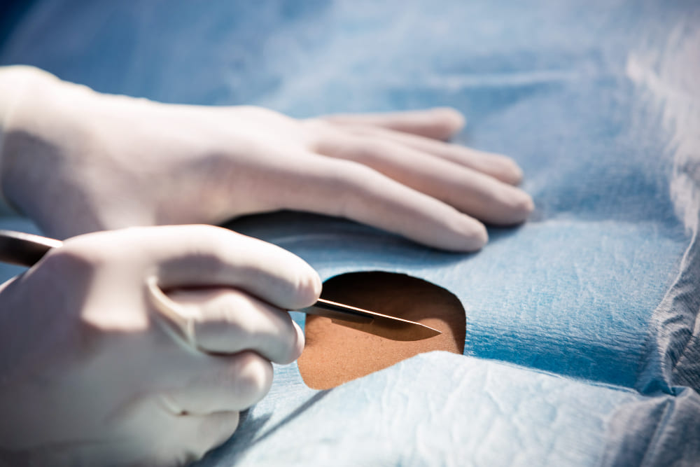 Hernioplastia umbilical